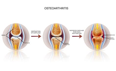 How PEMF Therapy Accelerates Articular Cartilage Repair ~ PEMF Therapy Education