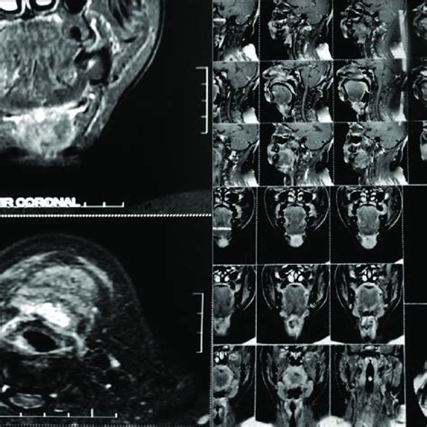 MRI shows an ill-defined heterogeneously enhancing soft-tissue lesion ...