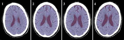 Icd 10 coding and documentation for subdural hematoma