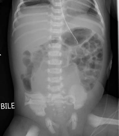 Bladder distension on abdominal radiograph | Radiology Case ...