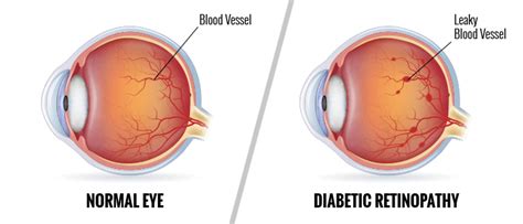 Diabetic Eye Disease – Buffalo NY | Dr. Mark Sorrentino - Family Eyecare and Eyewear Boutique