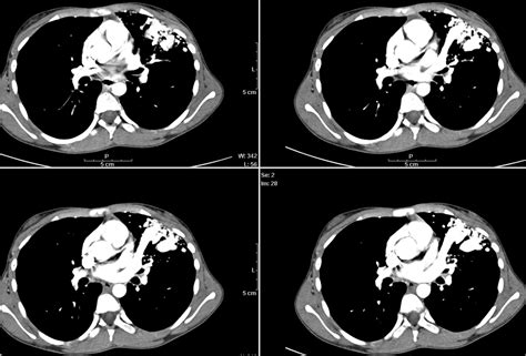 RADIOLOGY IMAGE SPOTTERS: Pulmonary avm