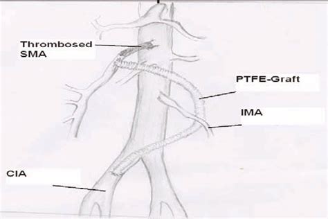 PTFE right common Iliac to mesenteric retrograde bypass graft.... | Download Scientific Diagram