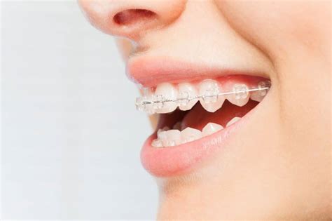 Can You Get Bottom Braces Only? - Suffolk Pediatric Dentistry