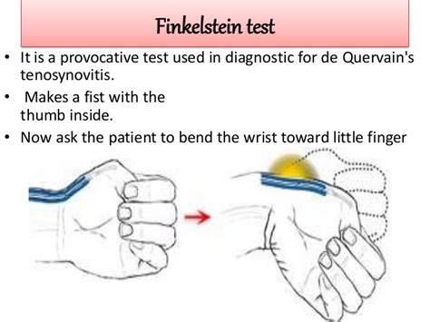 De Quervain's Tenosynovitis: Causes, Symptoms, Diagnosis & Treatment » How To Relief