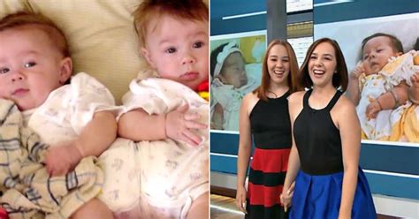 Conjoined twins separated through surgery at 7 months are happy and ...