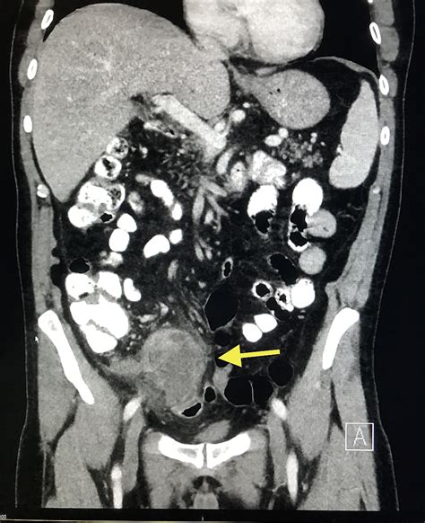 A Rare Case of Low-grade Appendiceal Mucinous Neoplasm: A Case Report | Cureus