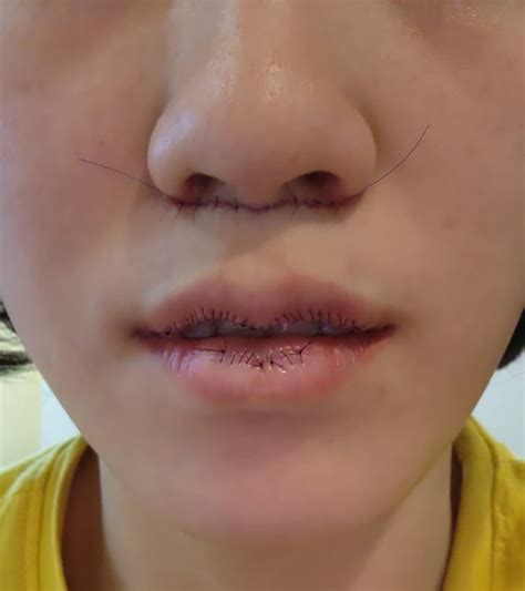 Lip surgery + lip lift before and after : r/PlasticSurgery