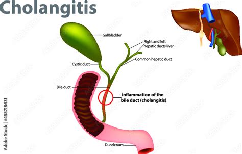 Cholangitis Triad