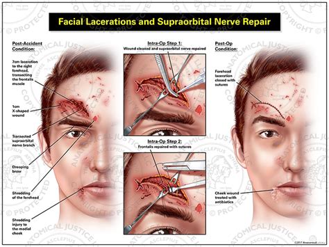 Facial Lacerations and Supraorbital Nerve Repair