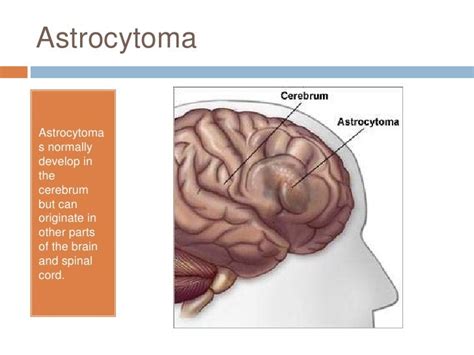 A Case Study: Astrocytoma