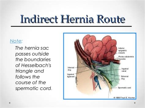 Inguinal hernia