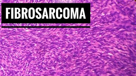 Fibrosarcoma Histopathology - YouTube