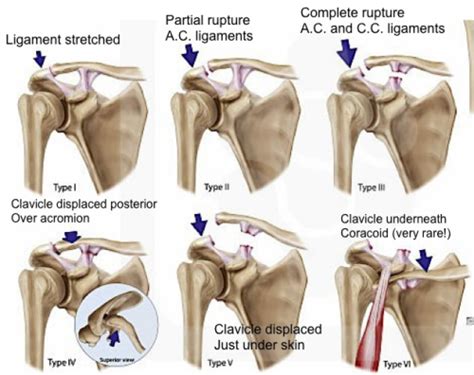 Boston Shoulder Institute – DC Joint Classification