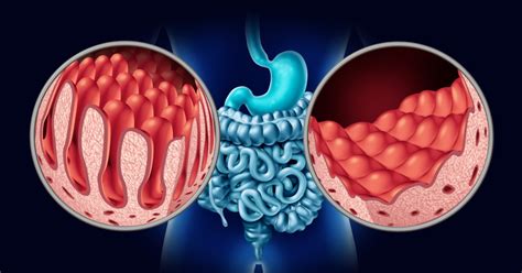 Best Drs & Hospitals in India for Intestinal Ischemia Treatment