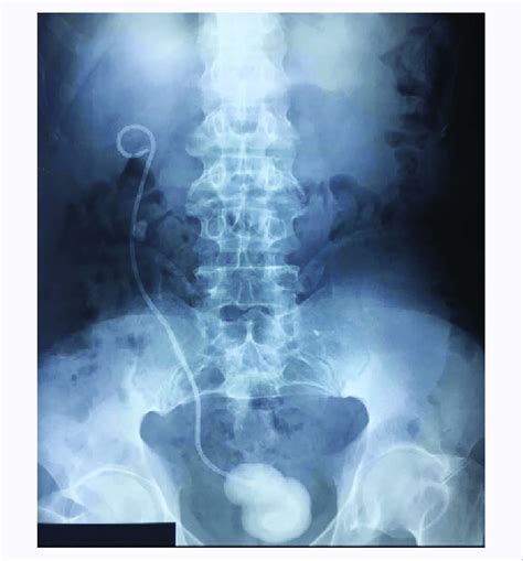 KUB X-ray showing encrusted double J stent. | Download Scientific Diagram