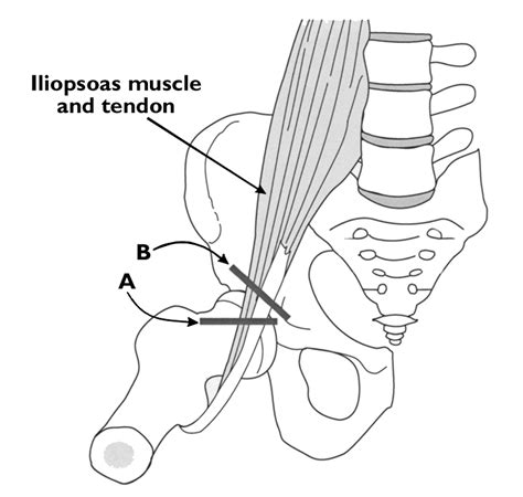 Iliopectineal Eminence Snapping Hip