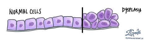 Dysplasie - MyPathologyReport.ca