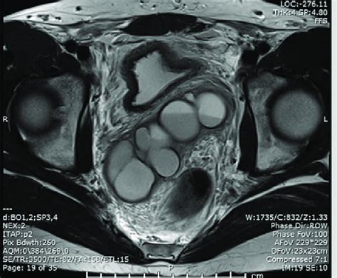 Axial MRI image shows large cystic structure posterior to bladder. | Download Scientific Diagram