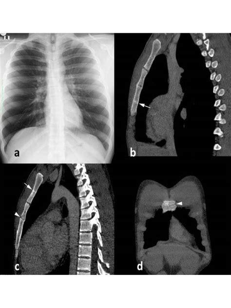 Fractured Sternum X Ray