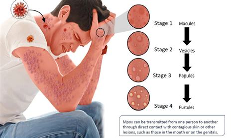 The Progression of MPOX Lesions: MPOX lesions initiate as flat bases ...