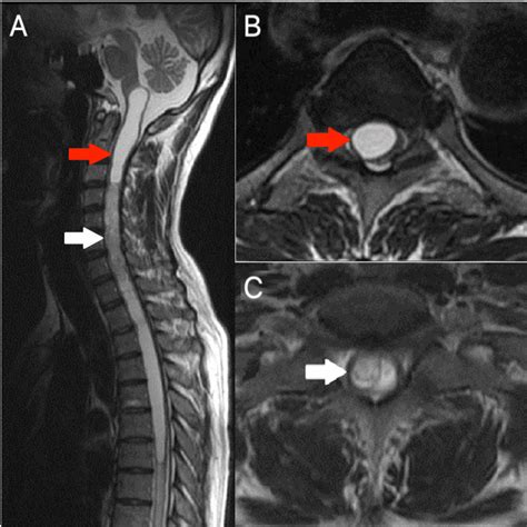 Giant-Cell Ependymoma of the Cervical Spinal Cord With Syringomyelia and Pathological ...