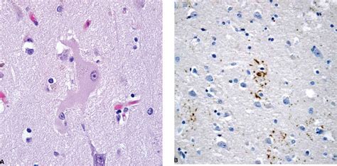 Corticobasal Degeneration | Neupsy Key