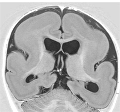 Lissencephaly Mri