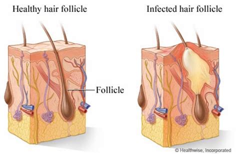 Hair Problems and Treatment : Causes of Folliculitis