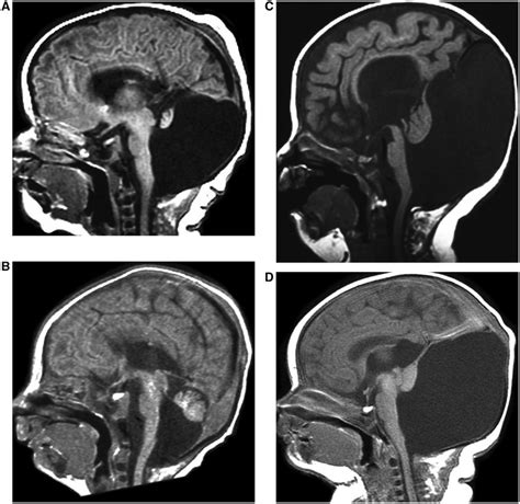 Dandy-Walker malformations with multiple associated genetic/clinical ...