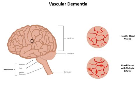 Vascular Dementia | The Foundation to Advance Vascular Cures