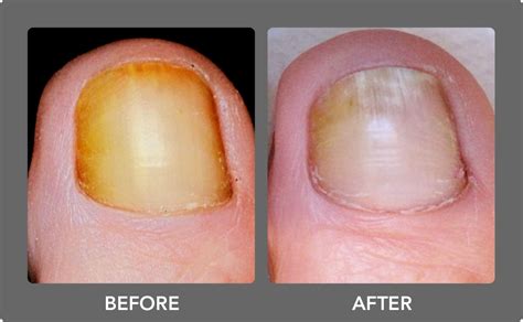 Toenail Fungus Laser Treatment | Boca Raton Podiatrist