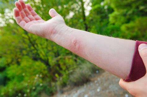 Wasp sting: what to do and remedies against swelling