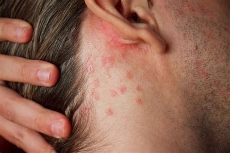 Guttate psoriasis - two lifestyle habits that trigger rash | Express.co.uk