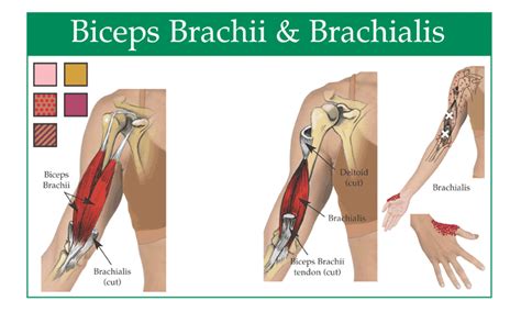 Physio Health: "Climber's elbow" - Brachialis Tendonitis