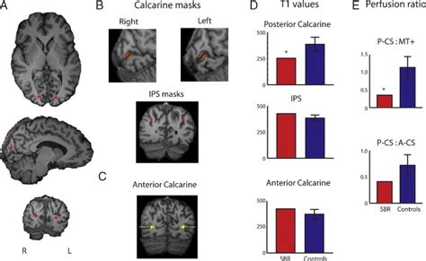 The gray matter of the posterior calcarine sulcus has a lower intensity... | Download Scientific ...