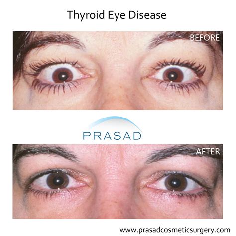 Thyroid Eye Disease Surgery/ Graves Eye Disease Surgery