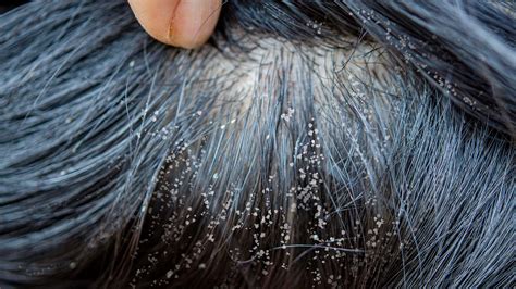 Head Lice: Causes, Symptoms, And Treatments | peacecommission.kdsg.gov.ng