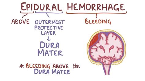 Epidural hematoma: Video, Anatomy & Definition | Osmosis