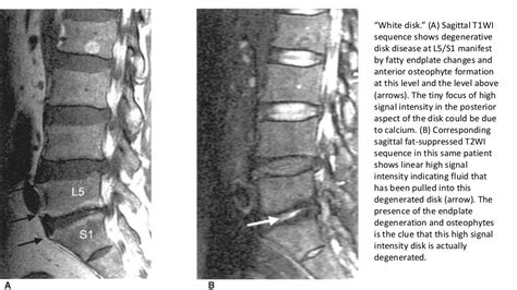 Imaging of lumbar spondylosis