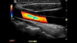 Carotid Artery: Carotid Artery Doppler