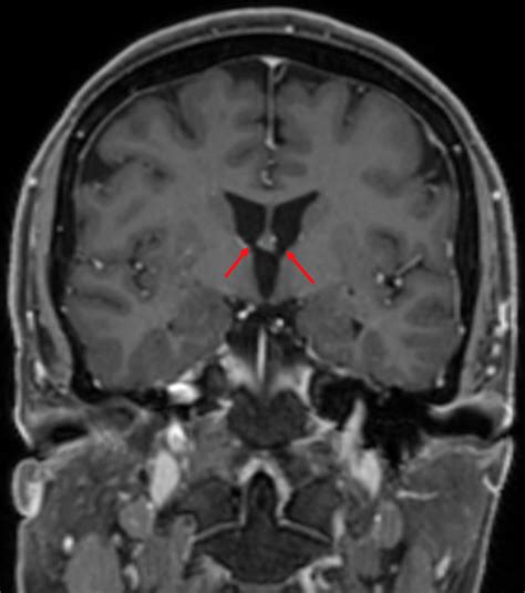 Foramen Monroi - Ars Neurochirurgica