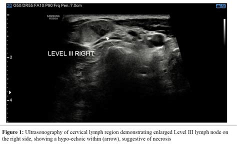 Enlarged necrotic cervical lymph node | Download Scientific Diagram