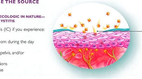 Understanding bladder infections: Causes, symptoms, and treatments - iPharma Expert Exchange