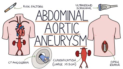 Understanding Abdominal Aortic Aneurysms - YouTube