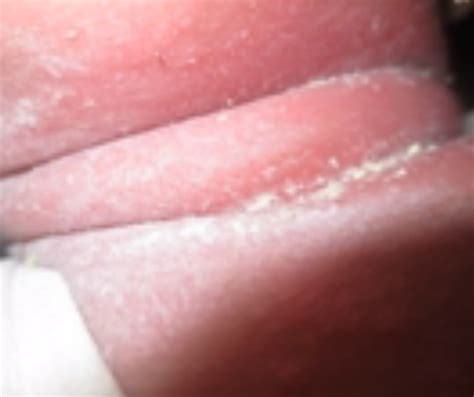 Intertrigo: Pictures, Rash, Symptoms, Causes, Treatment - HubPages