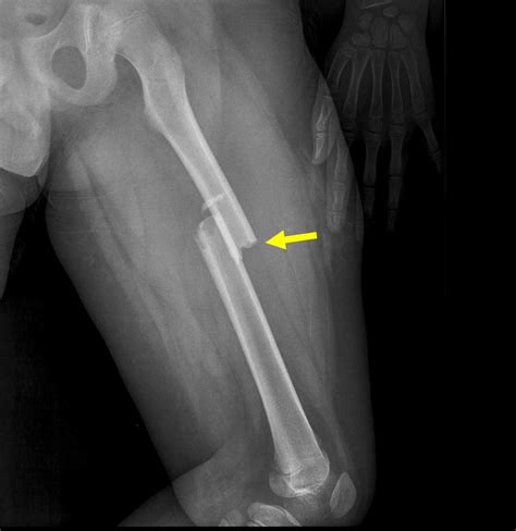 Cureus | Leg Length Discrepancy Due to Loss of Femoral Antecurvatum ...