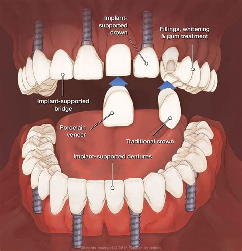 Full Mouth Reconstruction Los Algodones, Mexico - Mexicali - Cosmetic ...