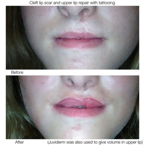 Scar revision on a cleft lip. www.cinnaomongirlclinic.ca Did you know you can make old scars ...