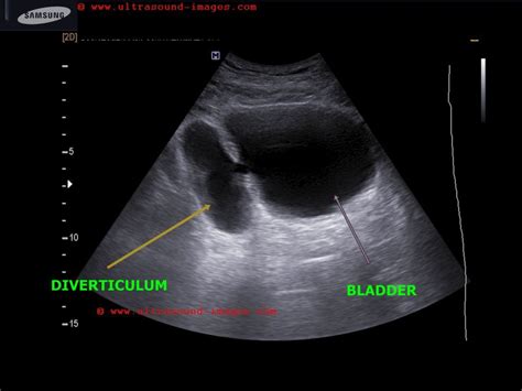 A Gallery of High-Resolution, Ultrasound, Color Doppler & 3D Images - Urinary bladder